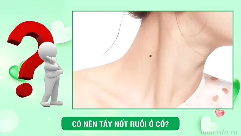 Nên làm gì khi có nốt ruồi ở cổ?