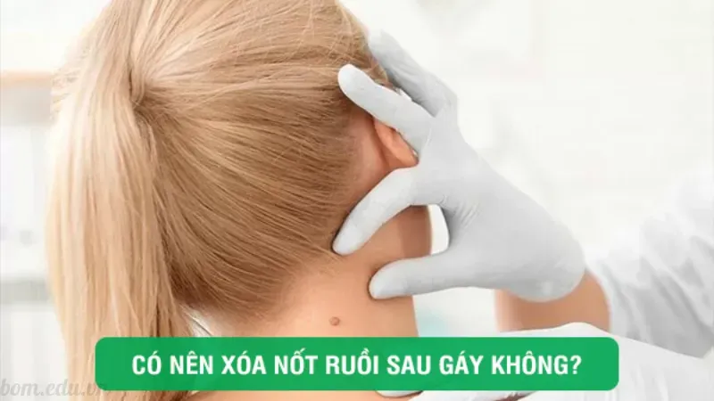 Có nên xóa nốt ruồi sau gáy không?