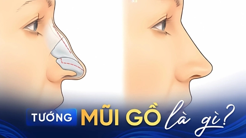 Tướng mũi gồ có tốt không? Các loại tướng mũi gồ phổ biến