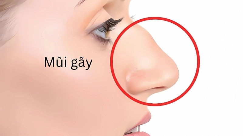 Tướng mũi gãy phụ nữ công danh và tình cảm dễ bị gián đoạn