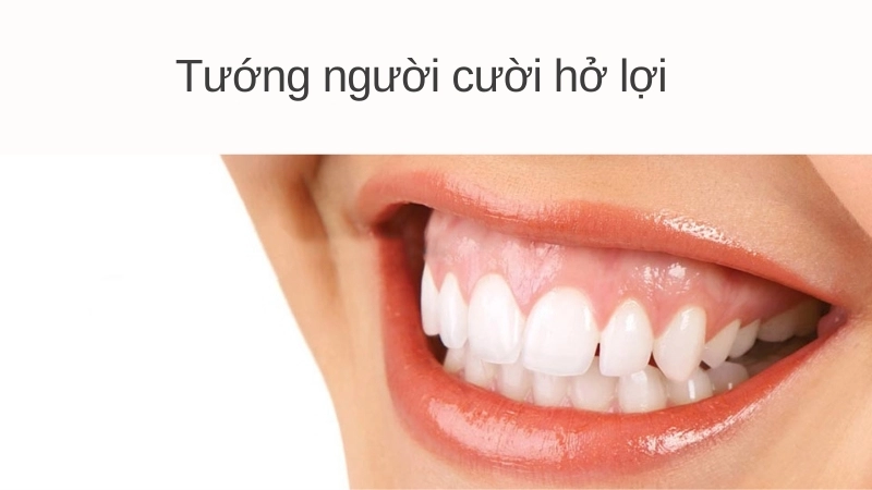 Ý nghĩa tướng người cười hở lợi theo nhân tướng học