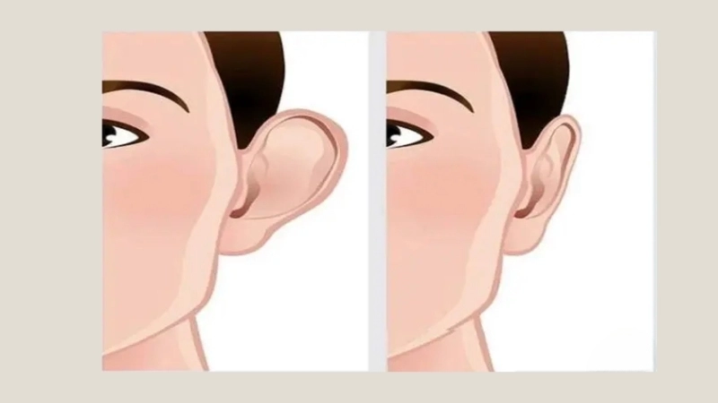 Ý nghĩa và cách hóa giải tướng tai nghèo hèn