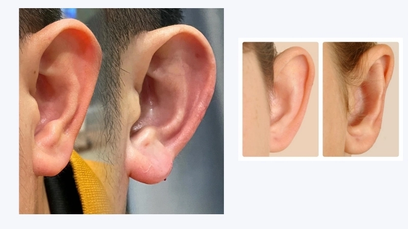 Tai vểnh theo phong thủy – Có phải là phúc lộc?