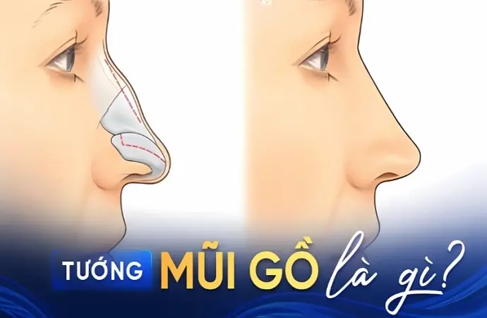 Xem tướng mũi gồ để hiểu rõ vận khí và sự nghiệp tương lai