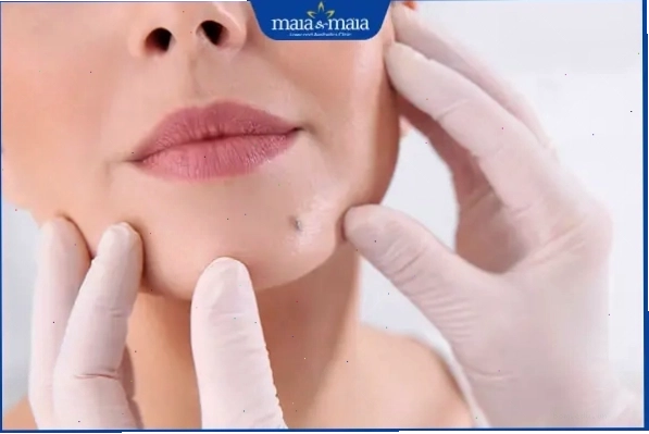 Bác sĩ thăm khám nốt ruồi trên mặt cho bệnh nhân
