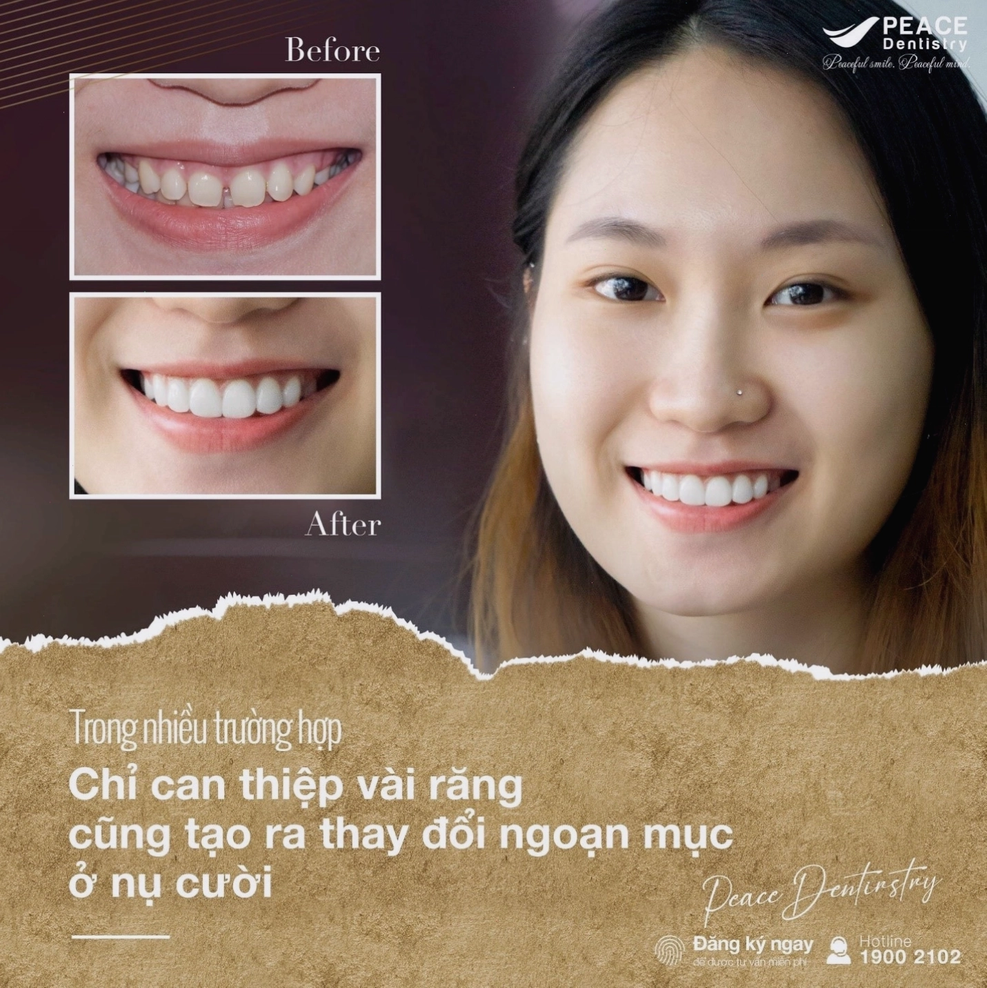 Ca lâm sàng dán sứ veneer cho răng cửa thưa