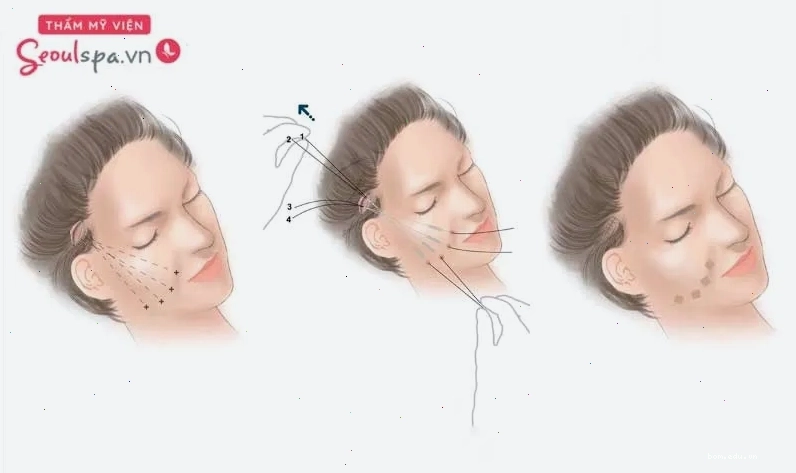 Căng chỉ xóa nhăn rãnh cười là một trong những phương pháp trẻ hóa giúp nâng cơ mặt và cải thiện độ đàn hồi da