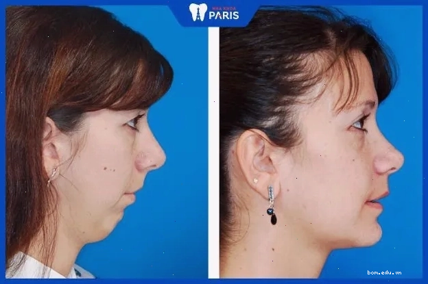 Hình ảnh minh họa cách nhận biết cằm lẹm so với cằm bình thường