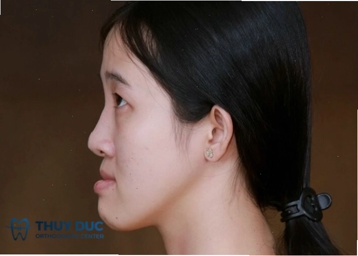 Hình ảnh minh họa cấu trúc khuôn mặt lưỡi cày với hàm dưới chìa ra