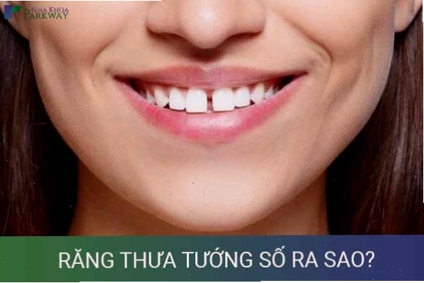Hình ảnh minh họa tình trạng răng cửa thưa với khoảng cách rõ rệt