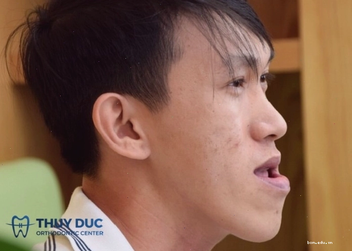 Hình ảnh người đàn ông có khuôn mặt vuông vắn và hàm dưới hơi đưa về phía trước
