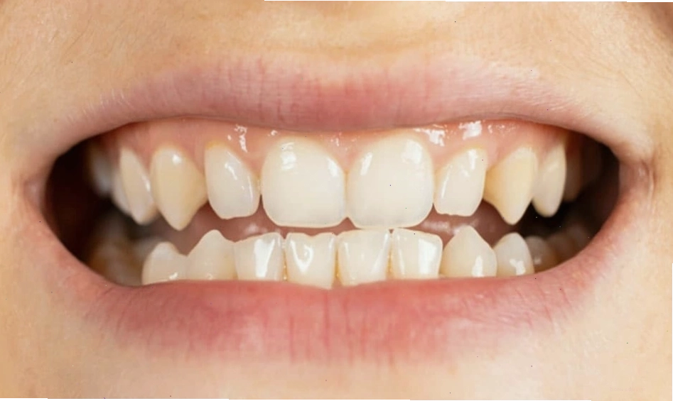 Hình dạng hàm răng móm có thể liên quan đến tính cách trầm lắng