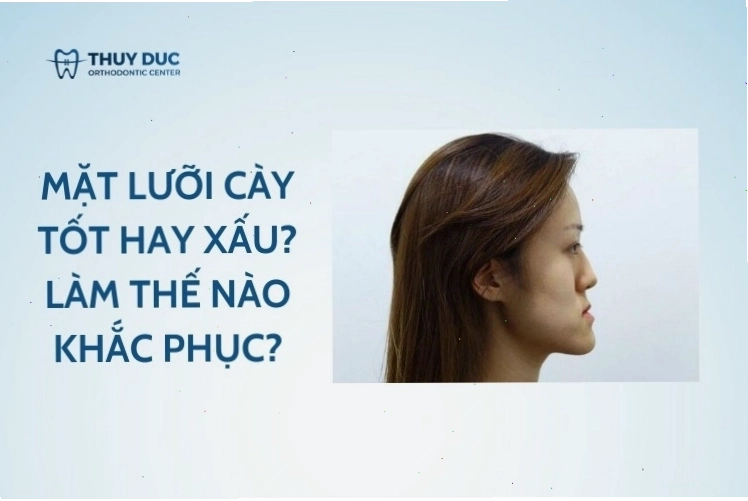 Khuôn mặt lưỡi cày với khớp cắn ngược rõ rệt