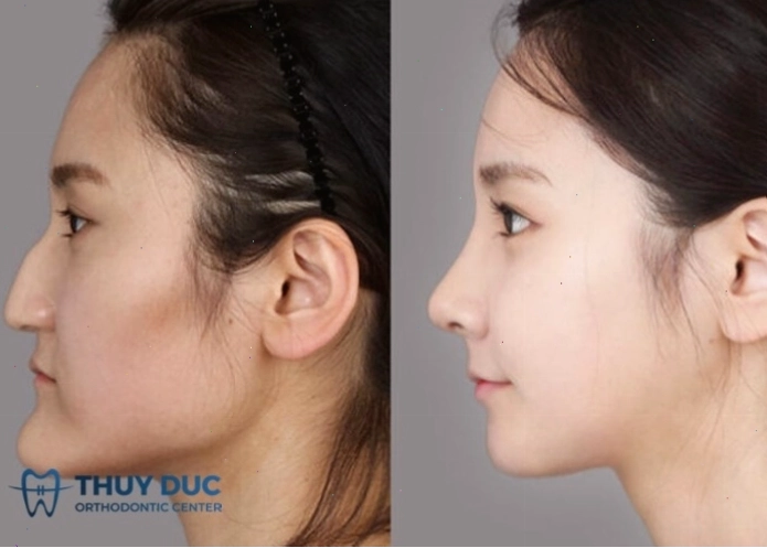 Minh họa kỹ thuật phẫu thuật chỉnh hàm
