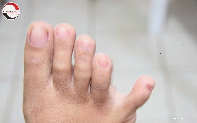 Ngón chân út dài bất thường