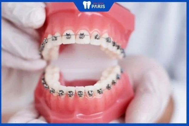 Niềng răng là một trong những phương pháp chữa cằm lẹm