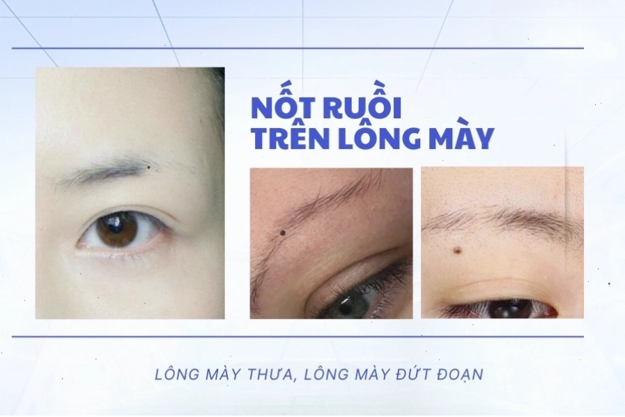 Nốt ruồi trên lông mày đàn ông và ý nghĩa phong thủy