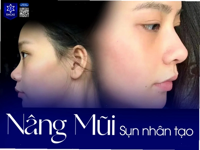 Phẫu thuật nâng mũi giúp cải thiện tướng mũi phụ nữ chưa hài hòa