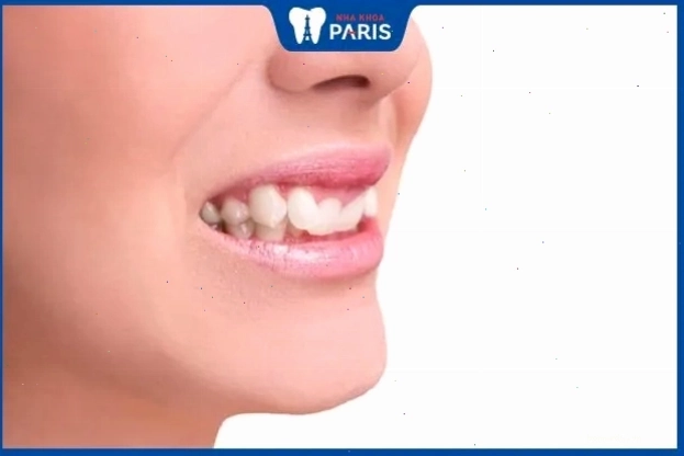 Phụ nữ có răng khấp khểnh thường gặp nhiều thử thách trong cuộc sống