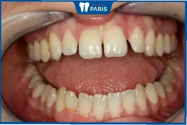 Phụ nữ có răng nhỏ thường có tính cách thực dụng và hay so đo