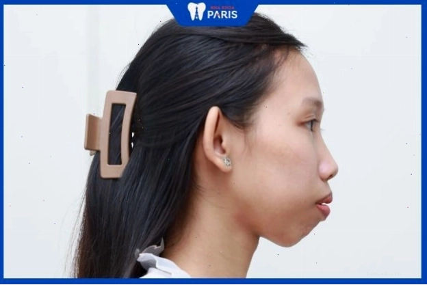 Phụ nữ sở hữu dáng cằm lẹm