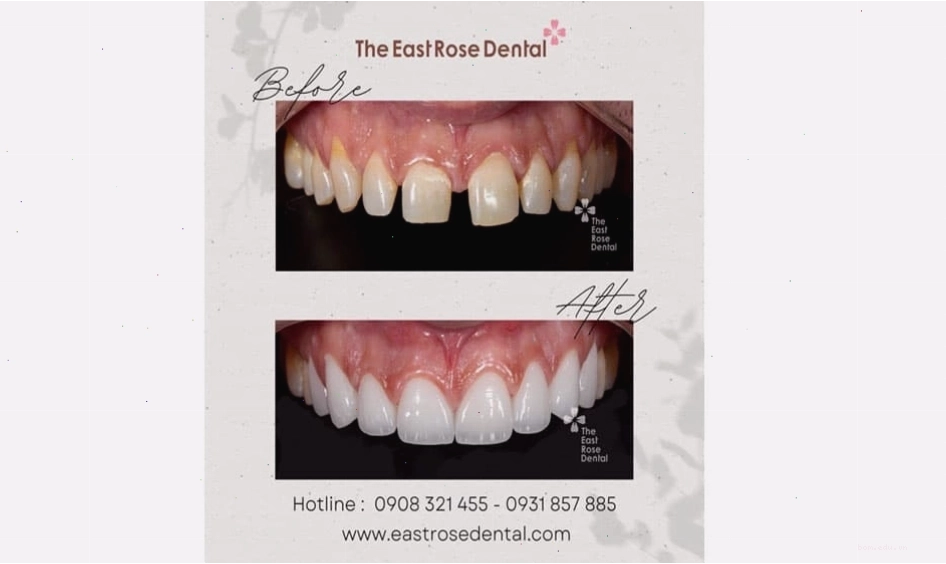Phương pháp dán veneer cải thiện thẩm mỹ răng cửa