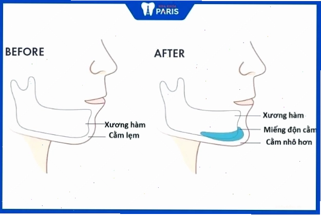 Phương pháp độn cằm để chữa cằm lẹm hiệu quả