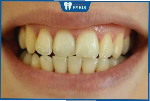 Răng ố vàng, xỉn màu có thể cải thiện bằng các phương pháp nha khoa thẩm mỹ