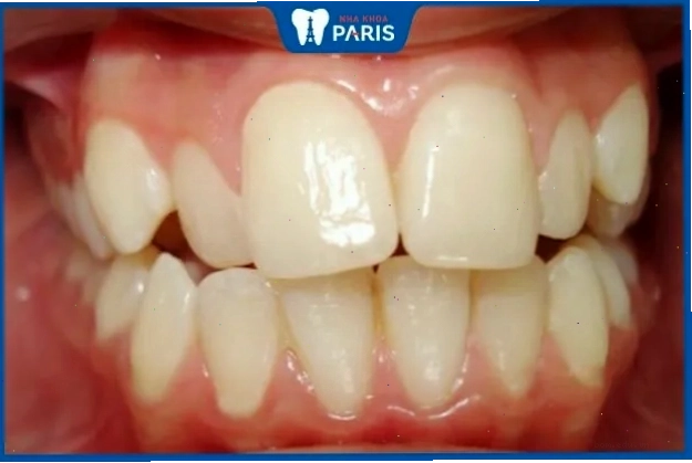 Răng thô to có thể khiến nụ cười kém duyên