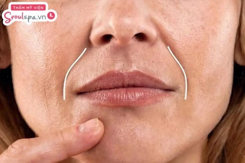 Rãnh cười sâu là đường rãnh tự nhiên xuất hiện từ hai bên cánh mũi và kéo dài xuống khóe miệng