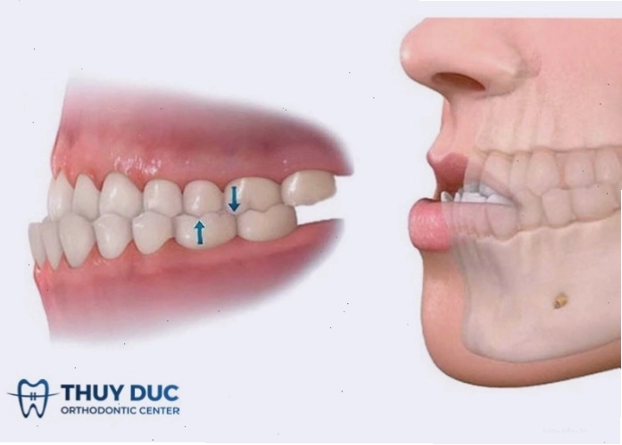 Sơ đồ minh họa khớp cắn ngược gây ra tình trạng mặt lưỡi cày