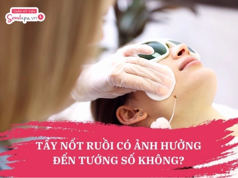 Tẩy nốt ruồi có xui không?