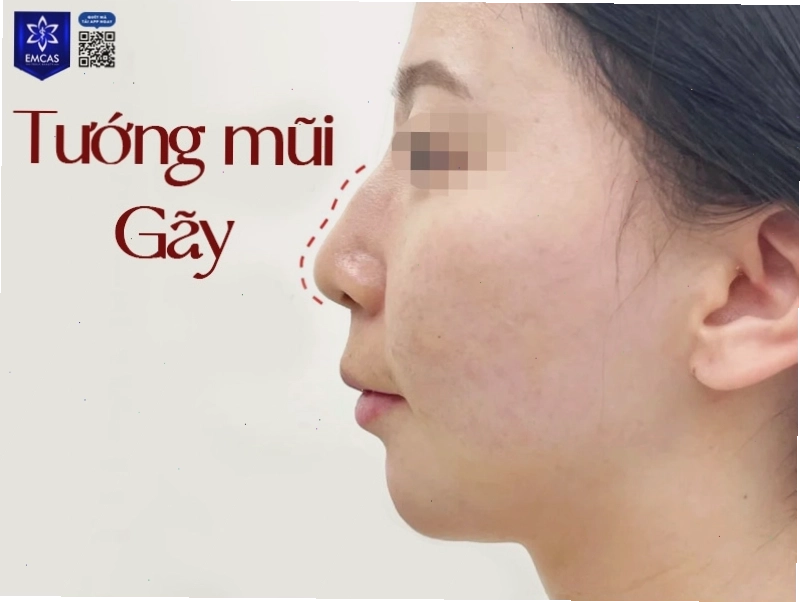 Tướng mũi gãy ảnh hưởng đến thẩm mỹ và vận mệnh