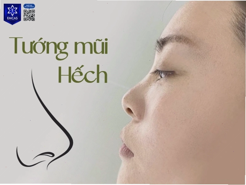 Tướng mũi hếch ở phụ nữ