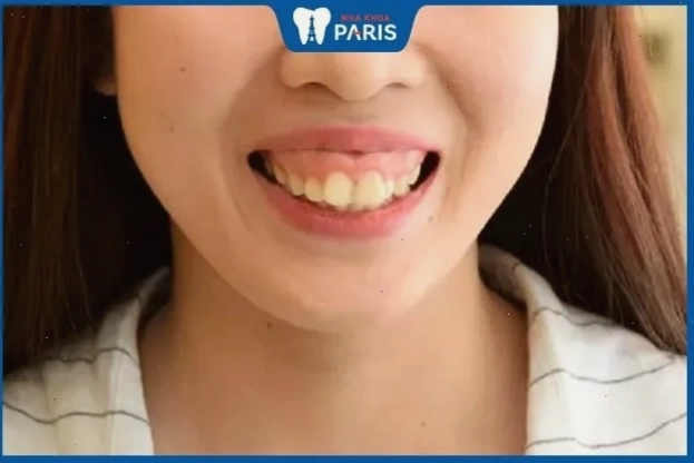 Tướng phụ nữ răng hô vẩu có thể gặp nhiều khó khăn trong mối quan hệ tình cảm