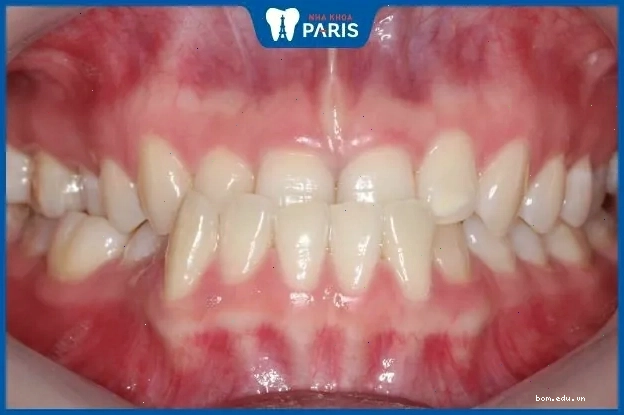 Xem tướng phụ nữ răng móm thường thể hiện tính cách bảo thủ