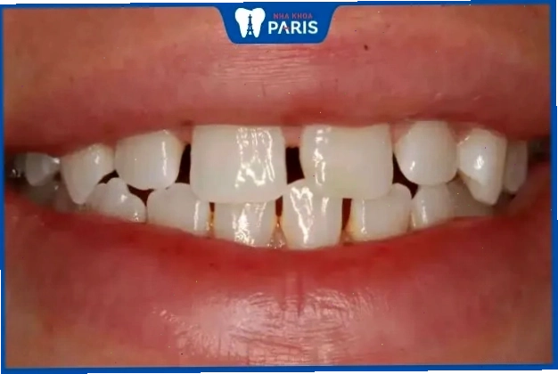 Xem tướng phụ nữ với răng cửa thưa có thể ảnh hưởng đến khả năng giữ tài lộc