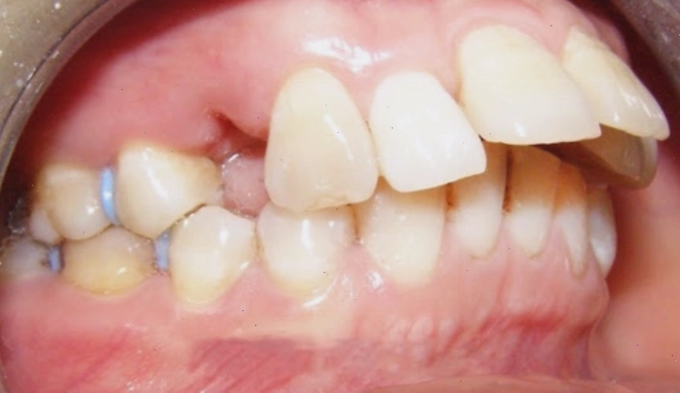 Xem tướng răng hô và ý nghĩa trong nhân tướng học