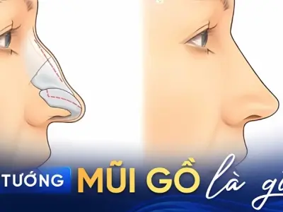 Xem tướng mũi gồ để hiểu rõ vận khí và sự nghiệp tương lai