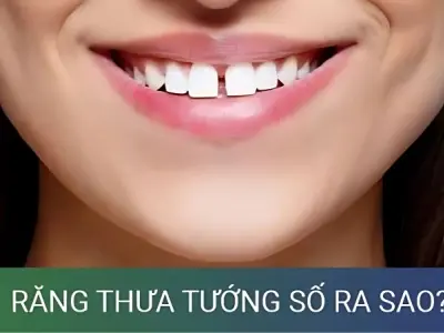 Khám phá vận mệnh qua tướng người răng thưa đầy đủ nhất